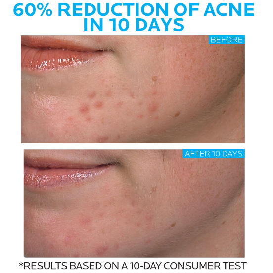 La Roche-Posay Effaclar Duo Dual Acne Spot Treatment With Benzoyl Peroxide 20ml - Image 2